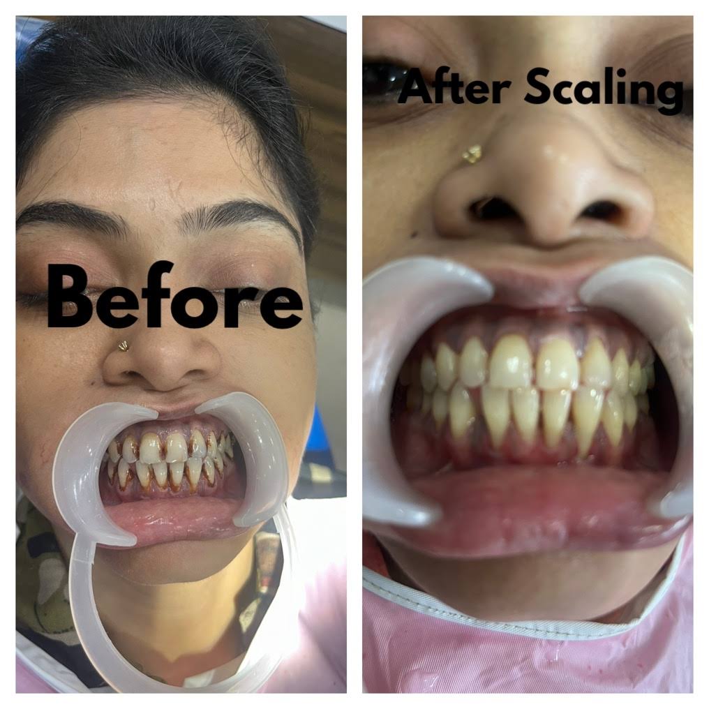 Teeth Cleaning (Scaling)+ Polishing product image
