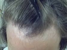 Sometimes, the wrong hairstyle with a thinning front can look unflattering and make hair look even thinner than it is. Frontal Fibrosing Alopecia Women S Receding Hairline