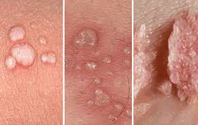 Image result for genital herpes