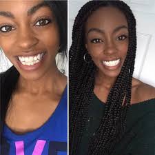 They also work directly with unitedhealthcare and aetna. Smile Direct Club We Can T Get Over This Gorgeous Before And After Of K Bell When I First Started Versus Today I D Say Smiledirectclub Works And I M Not Even