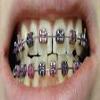 Ceramic Dental Braces product image