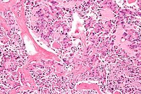 This is an abnormally folded, fibrillar protein that deposits in extracellular spaces in organs under certain pathological conditions. Medullary Thyroid Carcinoma Libre Pathology