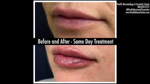 If we are only treating the marionette lines it is possible we could do it with 1/2 cc of juvederm. One Syringe Of Lip Filler Demo Video Using Juvederm Ultra Xc Seattle Wa Youtube