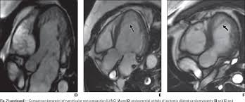 Image result for Left Ventricular Noncompaction
