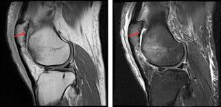 Information on the medial femoral condyle by the anatomyzone daily feed. Management Of End Stage Patellofemoral Post Traumatic Chondromalacia With Fresh Osteochondral Allograft International Congress For Joint Reconstruction