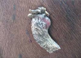 Image result for cornu cutaneum)