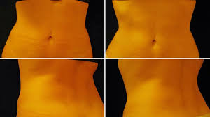 Cryolipolysis isn't surgery and doesn't use needles. Coolsculpting Wir Haben Die Methode Getestet Brigitte De