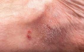 Why Are My Varicose Veins Itchy Vein Health Clinic Melbourne