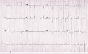 Image result for Synchronized Cardioversion