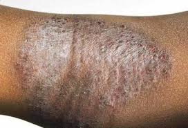 Image result for Atopic eczema atopic dermatitis