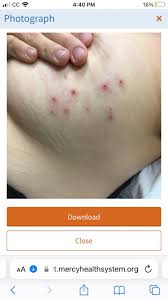 Image result for zoster under breasts