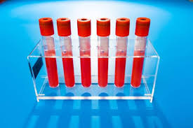 Bluttest Auf Down Syndrom Rest Unsicherheit Bleibt Medizin Transparent