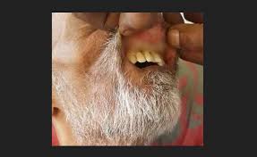 South Africa: Maggots in Mouth