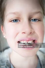 Permanent Teeth Injury Stock Photo