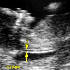 what is nuchal translucency screening normal reference