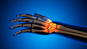 Image result for Hand Fracture