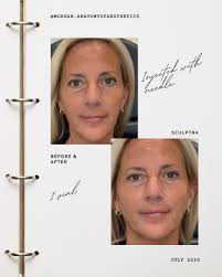 This before and after shows you what to expect immediately after your first  Sculptra treatment! This is what we look like with approximately 16  syringes worth of fluid in our faces! Not