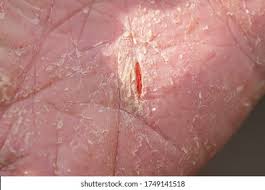 Image result for Neurodermatitis