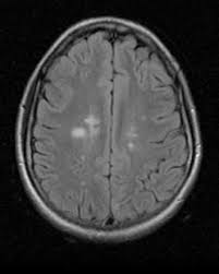 Multiple Sclerosis Radiology Reference Article Radiopaedia Org