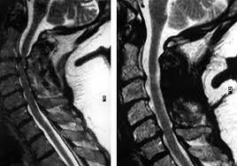 If you have it, please remember to check that your private health insurance covers mri of the cervical spine in case your doctor refers you for . Surgical Disorders Of The Cervical Spine Presentation And Management Of Common Disorders Journal Of Neurology Neurosurgery Psychiatry
