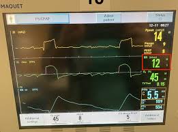 Image result for Respiratory Rate
