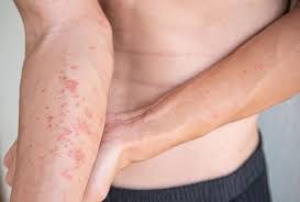 Image result for Atopic Dermatitis