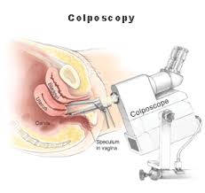 80% of women and 75% of men between the ages of 18 to 26 knew that hpv plays a role in cancers of the penis, anus, and mouth. Cervical Dysplasia Treatment Kimmel Cancer Center