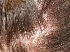 Look for a shampoo that hydrates, and avoid harsh ingredients like sulfates that can strip moisture out of your hair. Help For An Itchy Crown And Hair Loss Following Emotional Trauma