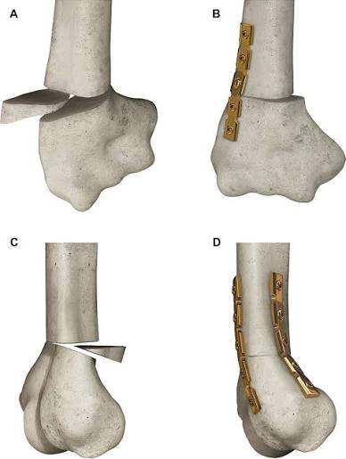 Corrective osteotomy for cubitus varus in middle-aged patients