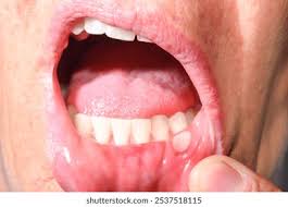 Image result for Labial mucosa