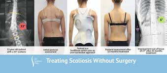 Uk Scoliosis Clinic Posts Facebook