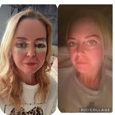 plastic surgery support group experience