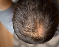 The anagen phase is when your hair grows—your hair follicle forms a new hair shaft. Types Of Hair Loss Treatments