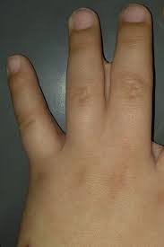 Image result for Syndactyly