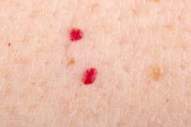If the appearance or bleeding of a cherry angioma becomes bothersome, they can quickly and easily be removed. Vascular Lesions Cherry Angiomas Causes And Treatments Revival Medi Spa