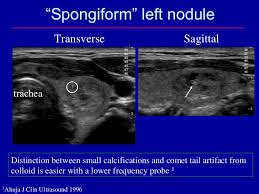 The Epidemic Of Thyroid Nodules Which Should Undergo Fine Needle Asp
