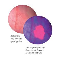 See the warning signs, causes, treatments, and prognosis for the main types of bladder cancer are named for the type of cells that become cancerous. Q A Blue Light Cystoscopy Versus White Light Cystoscopy In The Diagnosis Of Bladder Cancer Fox Chase Cancer Center Philadelphia Pa