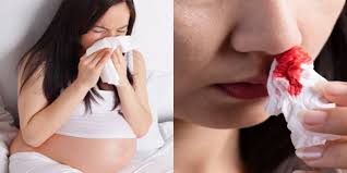 Bagaimanakah anda mengelakkan daripada hidung berdarah? Hidung Berdarah Saya Nak Tanya Normal X Hidung Berdarah Say