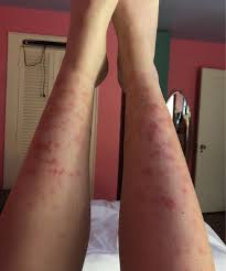 The laser hair removal cost for the large body areas such as back and legs is minimum $600 and at the same time, the cost of face and neck ranges in this amount. What S This Reaction Called After Laser Hair Removal On Legs For The First Time Photos
