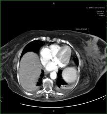 Can a ct scan pick up breast cancer. Lymphoma Of The Breast A Mimic Of Inflammatory Breast Cancer World Journal Of Surgical Oncology Full Text