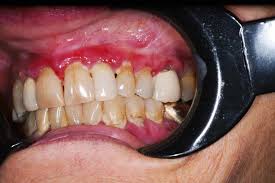 Image result for Mouth ulcers symptoms roof of the mouth