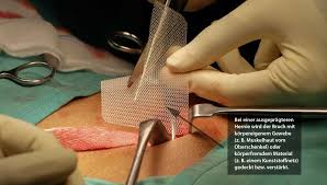 In diesen fällen droht ein absterben des eingeklemmten gewebes und nachfolgend ein darmverschluss und eine bauchfellentzündung. Bauchwandbruch Operation Von Nabel Oberbauch Narbenbruch