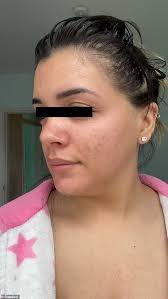 Think of our skin + digestion vitamins as a tool when experiencing conditions such as symptoms of acne, pimples, skin eruptions, mild eczema or dermatitis. Jshealth How Mum Transformed Her Skin In Just Eight Weeks Daily Mail Online