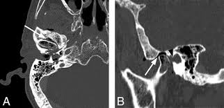 Image result for Osteomyelitis Bone Scan