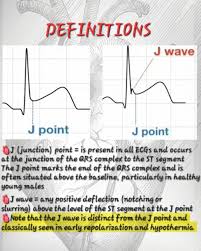Image result for Early Repolarization