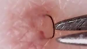 These pesky ingrown hairs can even cause pimples. Tweezist Is The Insta Account You Need In Your Life