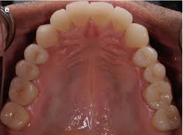 Image result for Occlusal