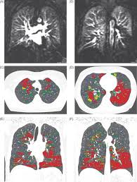 Pulmonary parenchymal opacities other than infection alan s. Assessment Of The Relationship Between Lung Parenchymal Destruction And Impaired Pulmonary Perfusion On A Lobar Level In Patients With Emphysema European Journal Of Radiology