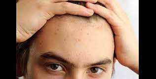 We've listed down a few to help you figure the possible root cause in your case. How To Get Rid Of Forehead Pimples Causes And Treatment