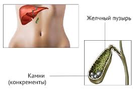Zhelchnokamennaya Bolezn Novosti I Akcii Evropejskogo Medicinskogo Centra Ugmk Zdorove